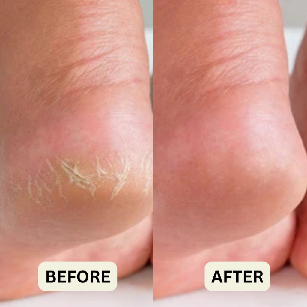 ManuRestore™ Heel Stick