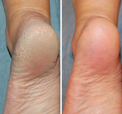 ManuRestore™ Heel Stick